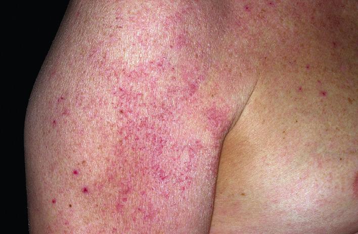 Fig. 2.18, Subacute eczematous inflammation. Patchy, ill-defined eczema is seen on the arm and trunk. Individual crusted papules suggest the possibility of scabies in the differential diagnosis.