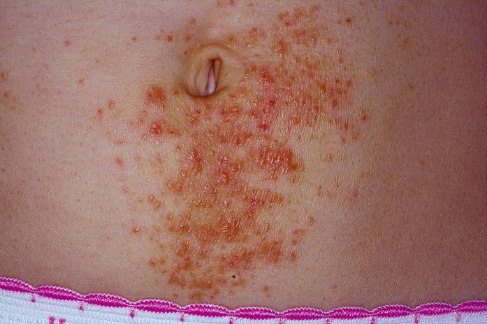 Fig. 2.19, Subacute eczematous inflammation. A subacute dermatitis consisting of erythematous papules, patchy erythema, and crusting. This location is more typical for metal contact allergy due to nickel. Often the dermatitis spreads elsewhere, a process referred to as autoeczematization .