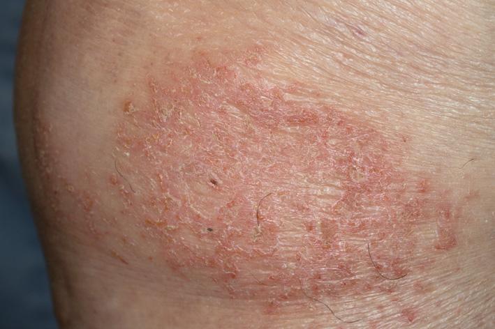 Fig. 2.20, Subacute eczema. Note the fissuring on the surface, the cracked appearance and scaling, some surface crust, and erythema.