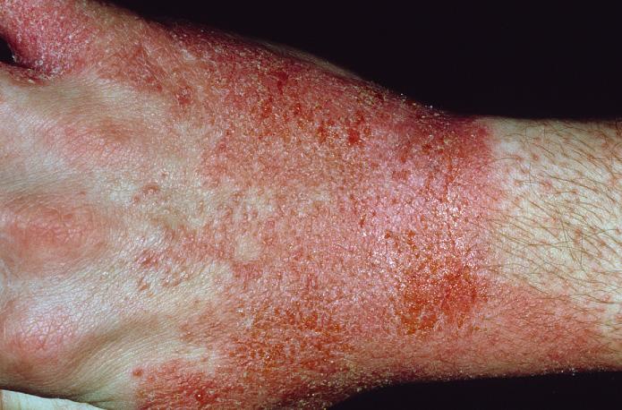 Fig. 2.21, Subacute eczema of the dorsum of the hands is seen here with weeping, crusting, vesiculation, and erythema.