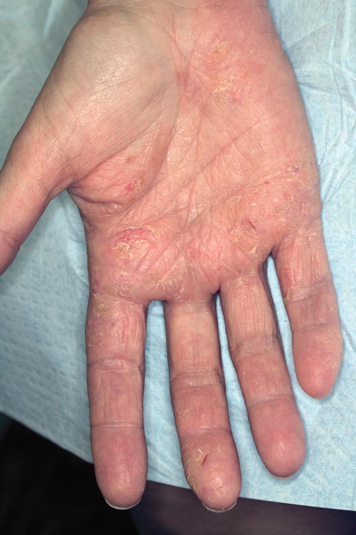 Fig. 2.22, Subacute eczematous dermatitis of the hand. Fissuring, scaling, and dull pink erythema in ill-defined patches. This is a typical appearance of irritant dermatitis from repeated hand washing.