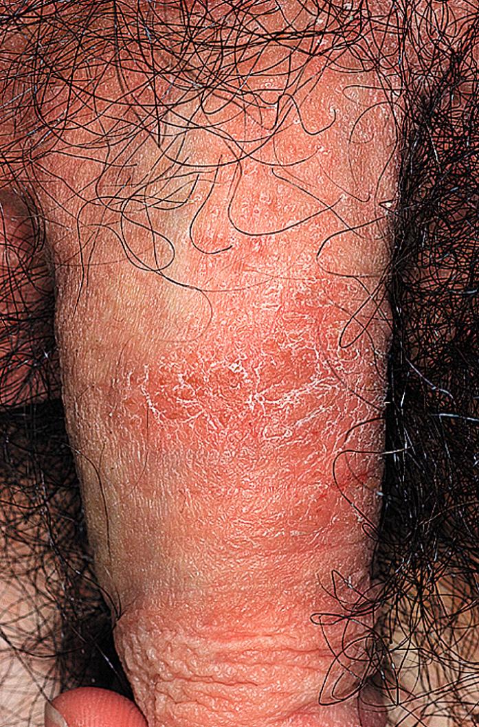 Fig. 2.23, Subacute eczematous inflammation is characterized by erythema and scaling. There are no blisters. An allergic reaction to neomycin ointment produced this eruption.