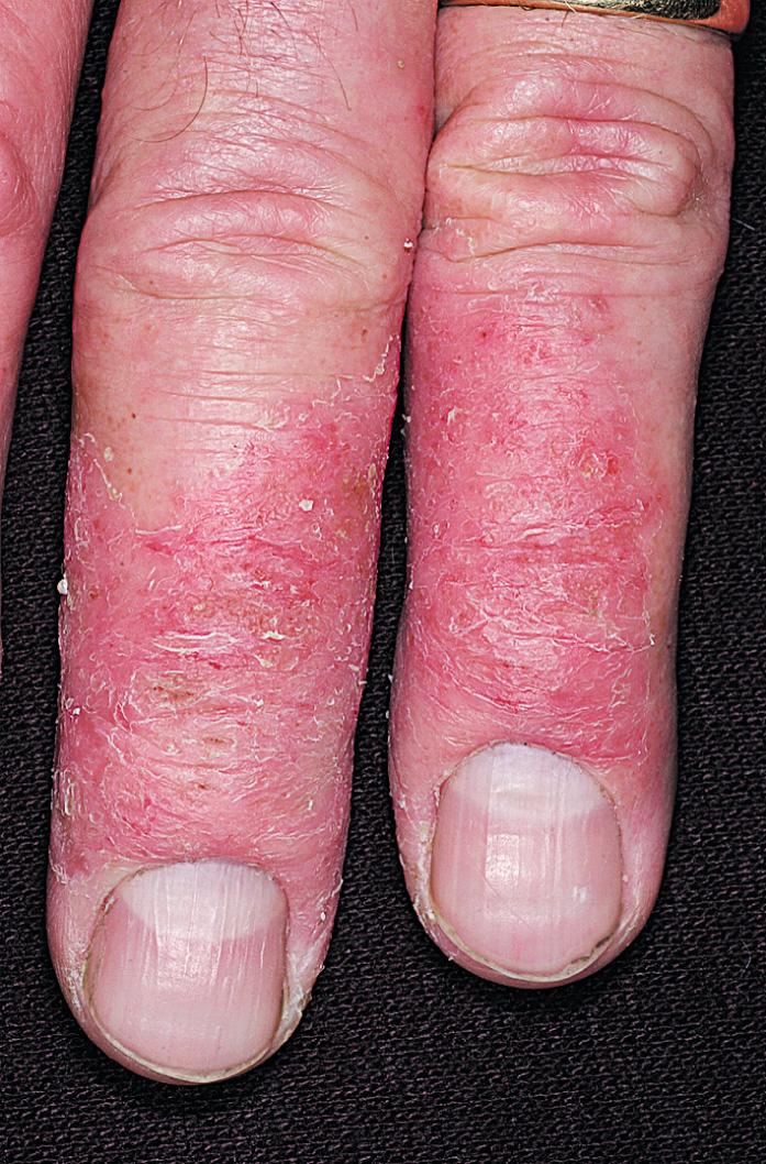 Fig. 2.24, Subacute eczema of the fingers is common in people who have repeated exposure to moisture. New mothers who wash and clean are at a high risk for irritant eczema.
