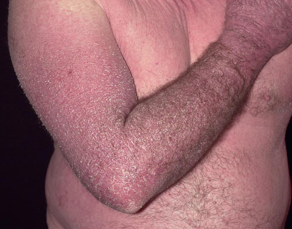 Fig. 2.25, Subacute eczema with indistinct borders, erythema, scaling, and pruritus. This is the appearance of a long-standing contact allergy. Patch testing should be considered.