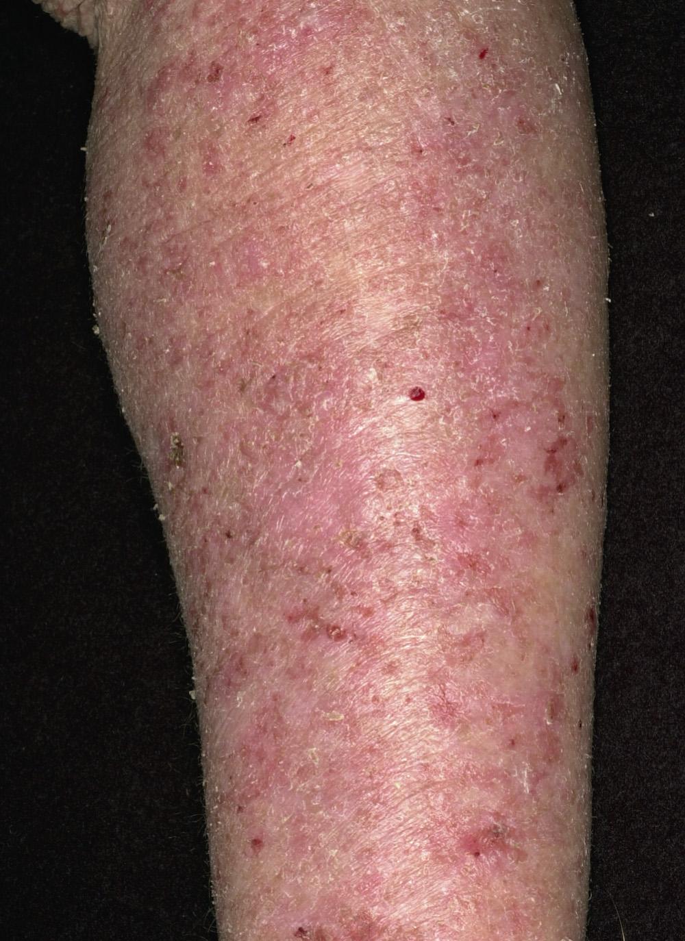 Fig. 2.26, The forearm of a patient with generalized atopic dermatitis. Subacute eczema is characterized by ill-defined, coalescing papules, erosions, crusting, scaling, and early lichenification.