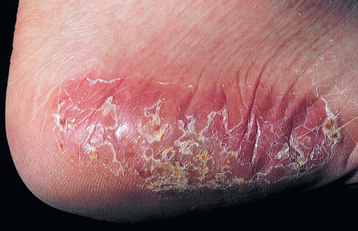 Fig. 2.28, Eczema resembling psoriasis. Repeated vesiculation within this patch leads to subacute eczema.