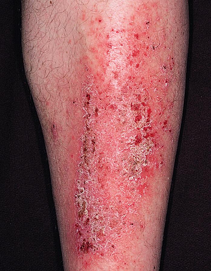 Fig. 2.29, Weeks of scratching and rubbing with the heel had caused skin thickening. The chronically inflamed and excoriated skin has become infected. Crust and purulent material cleared after a course of cefalexin 500 mg twice daily for 7 days.