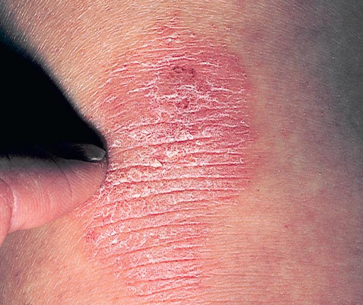 Fig. 2.30, Chronic eczematous inflammation is characterized by dull pink erythema, thickening of the skin (lichenification), and scaling. Note the increased linear markings within this plaque.