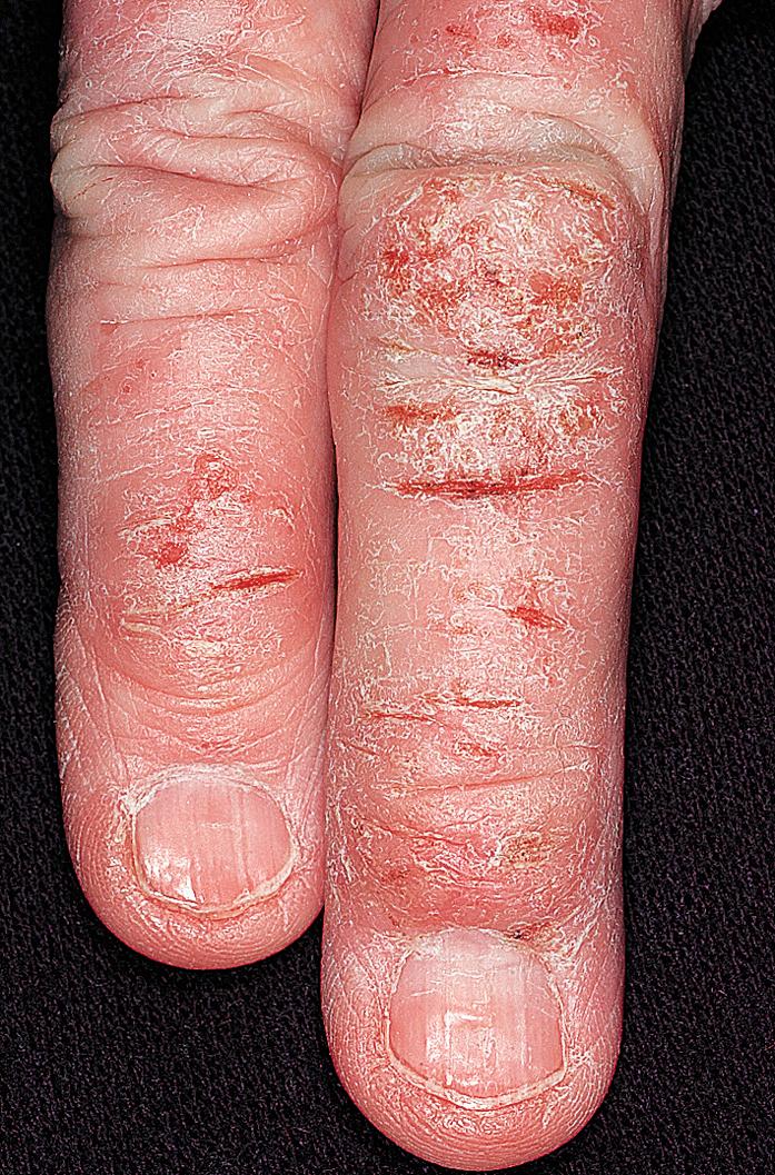 Fig. 2.31, Chronic eczema of the dorsal fingers characterized by linear painful fissures, erythema, scaling, and swelling. Contact irritant versus contact allergic dermatitis should be considered, and patch testing should be done if patient does not get better with initial management.