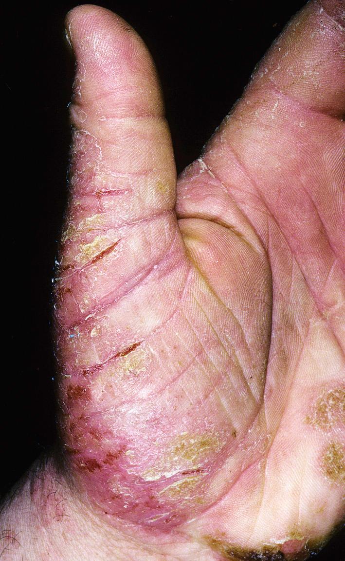 Fig. 2.32, Chronic hand dermatitis characterized by erythema, fissuring, scaling, and thickened, retained scale (hyperkeratosis). Contactants, both irritant and allergic, should be considered. Patch testing is indicated for recurrent disease.