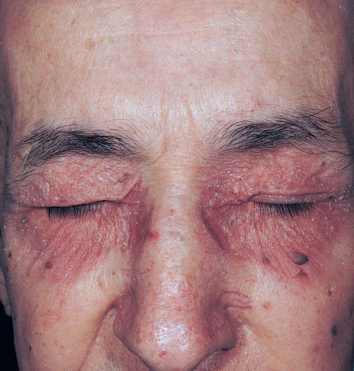 Fig. 2.33, Subacute and chronic eczema of the eyelids. Fine scaling and erythema. This picture could represent changes of irritant, allergic, or atopic dermatitis.