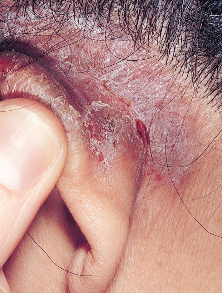 Fig. 2.34, Chronic eczematous inflammation. Fissuring, erythema, and scaling are seen in the postauricular crease. Differential diagnosis includes contact allergy and atopic eczema.