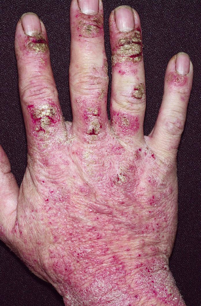 Fig. 2.37, Erythematous scaling patches and heavy crusting. Weeping is a feature of acute eczema. The heavy crust can signify a staphylococcal secondary infection within this eczematous hand dermatitis.
