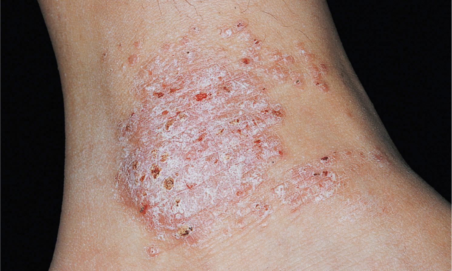 Fig. 2.39, A lesion of lichen simplex chronicus. Note the sharp demarcation of affected skin.