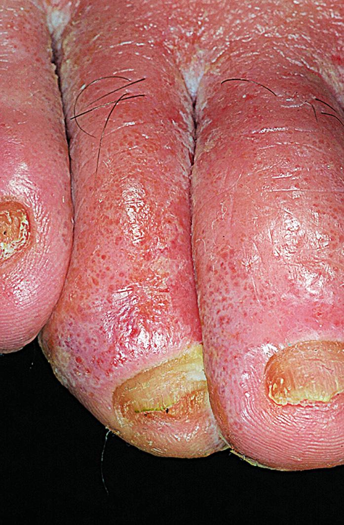 Fig. 2.4, Acute eczematous inflammation. Vesicles and intense itching are the hallmark of acute eczema. This patient was allergic to rubber allergens in shoes.