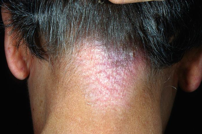 Fig. 2.41, Chronic eczematous dermatitis at the nape of the neck is common in patients with atopic dermatitis. This can be easily mistaken for psoriasis.