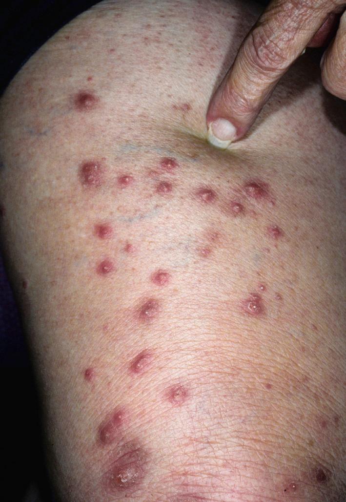 Fig. 2.48, Prurigo nodularis may be considered a localized, nodular form of lichen simplex chronicus. These lesions are intensely pruritic and are perpetuated by picking and scratching. Nodules are dome shaped, erythematous, and firm and may have a crusted surface.