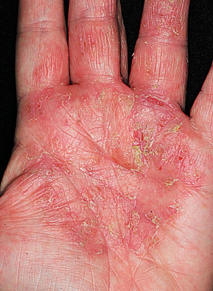 Fig. 2.49, Irritant hand eczema occurred in this woman who cleaned without glove protection. Scratching prolongs the disease.