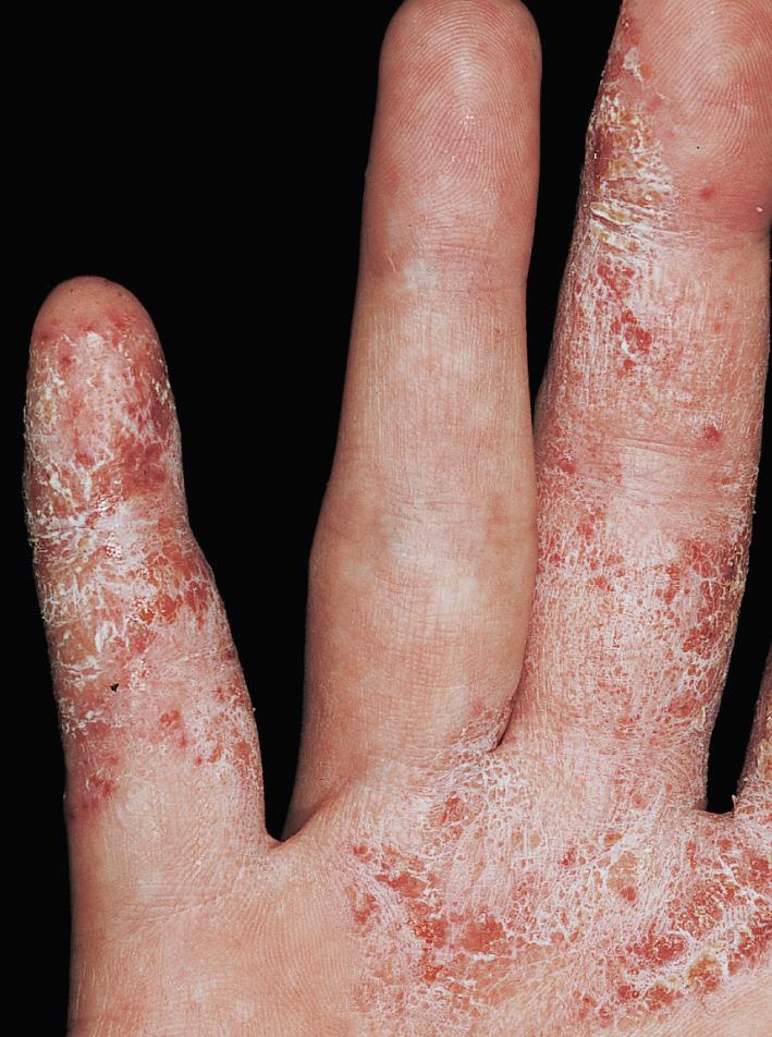 Fig. 2.50, Irritant hand dermatitis. The vesicular nature of this eruption also suggests a contact allergic component. Patch testing would be helpful in this case to identify any contact allergens.