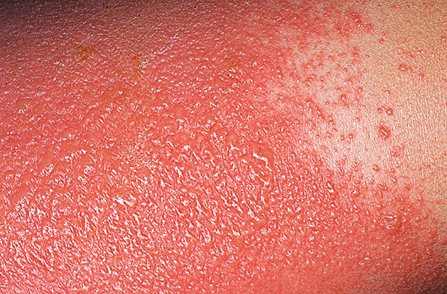 Fig. 2.5, Acute eczema. Poison ivy may cause intense acute eczematous inflammation. Vesicles and blisters form on a red base. The blisters may coalesce and become very large. The itching is unbearable and is best controlled with cold wet dressings.