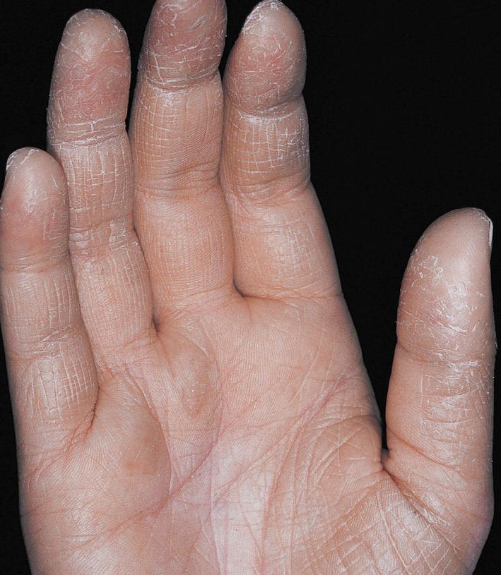 Fig. 2.51, Irritant hand dermatitis. The findings are mild erythema and xerosis. This is an early stage of irritant contact dermatitis. Repeated exposure to irritants, such as soaps, detergents, and water, are frequently the cause.