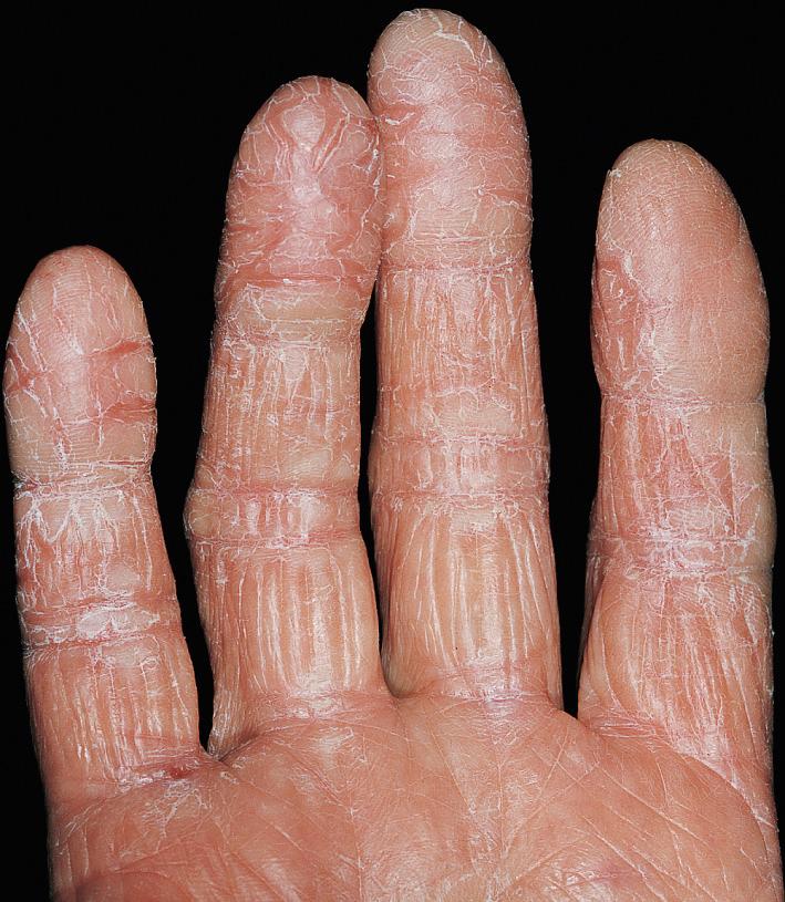 Fig. 2.52, Irritant hand dermatitis. Subacute eczematous inflammation with erythema, painful fissuring, and scaling.