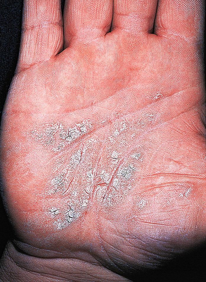 Fig. 2.53, Hand eczema. Dry, thick, fissured hyperkeratotic eczematous plaques are difficult to treat. They last for months or years and may be impossible to distinguish from psoriasis.