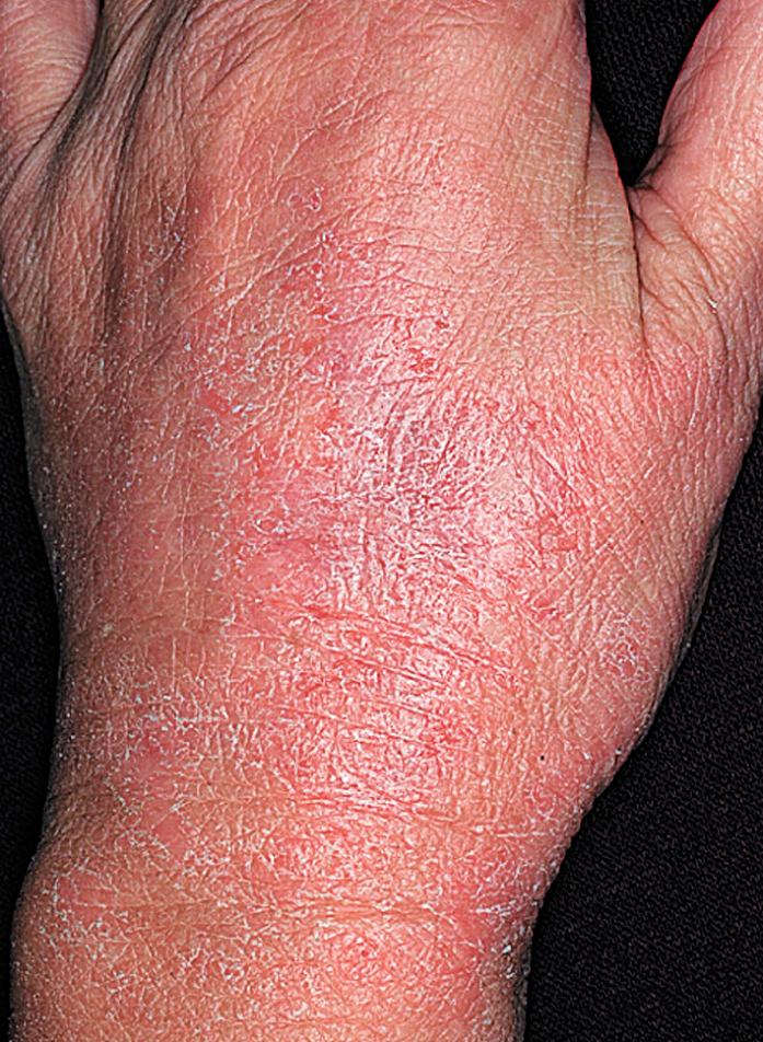 Fig. 2.54, Hand eczema. Constant hand washing has perpetuated this chronic eczematous dermatitis on the back of the hands. The eruption cleared rapidly when a group IV topical steroid and plastic occlusion were applied at bedtime for 7 days.