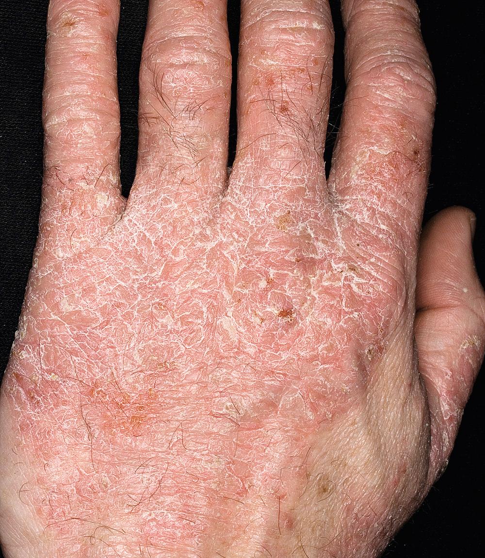 Fig. 2.55, Eczematous dermatitis of the hand. This is usually very pruritic. Switching from multiple topical products should be discouraged. A bland nonfragranced thick emollient should be used as part of the treatment regimen, several times a day to try to heal the barrier.