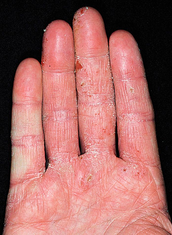 Fig. 2.57, Irritant hand dermatitis on the palmar surface of the fingers is difficult to treat and tends to be chronic. Intermittent topical steroids, constant moisturizing, and protection with gloves are the mainstays of treatment. Vinyl gloves are best as they avoid the most common glove allergens.