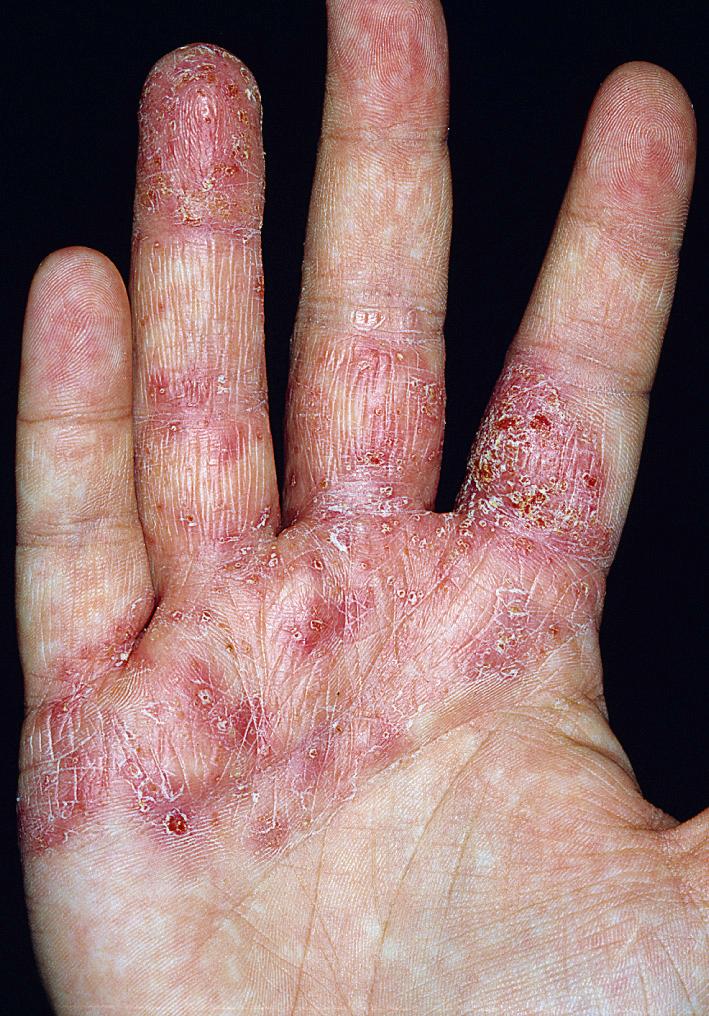 Fig. 2.58, Erythema, vesicles, and crusting of the fingertips to the “apron” area of the palm. This eczematous dermatitis may be irritant, allergic, or endogenous.