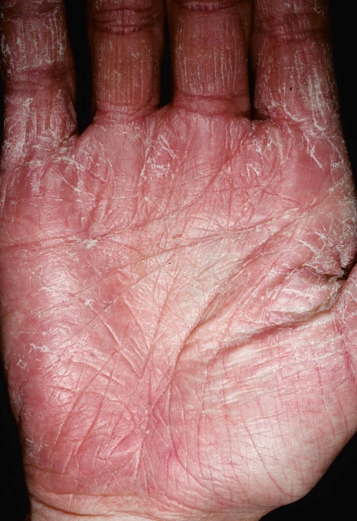 Fig. 2.59, Erythema, scaling, and sharp demarcation are features of this hand dermatitis. A potassium hydroxide examination is reasonable.