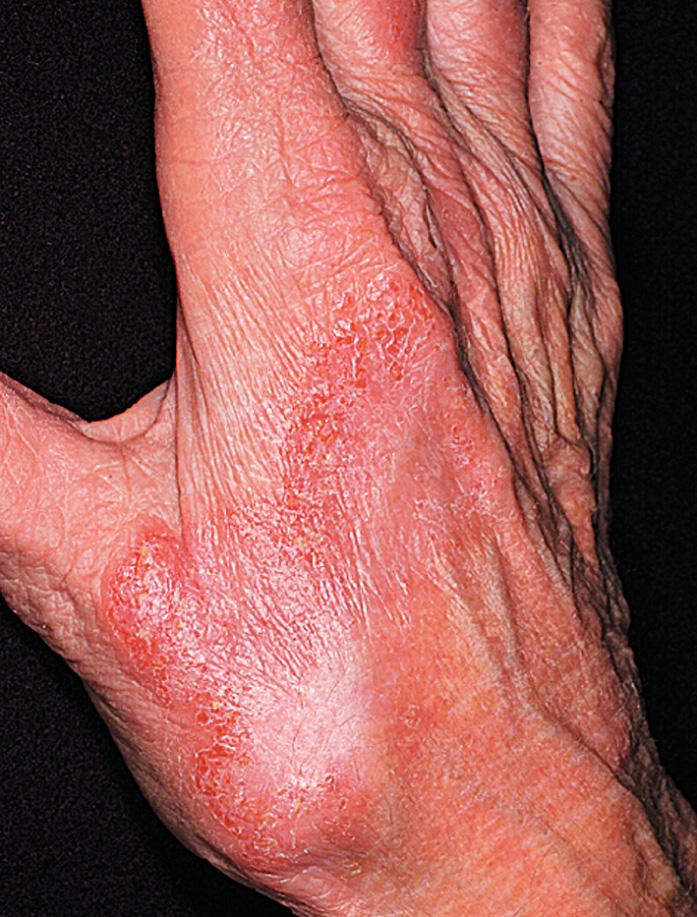 Fig. 2.60, Irritant contact dermatitis was caused by exposure to cleaning solutions. The rash persisted with scratching. The potassium hydroxide preparation was negative for fungi. Psoriasis may have a similar appearance, and even a biopsy may not be able to differentiate the two diseases.