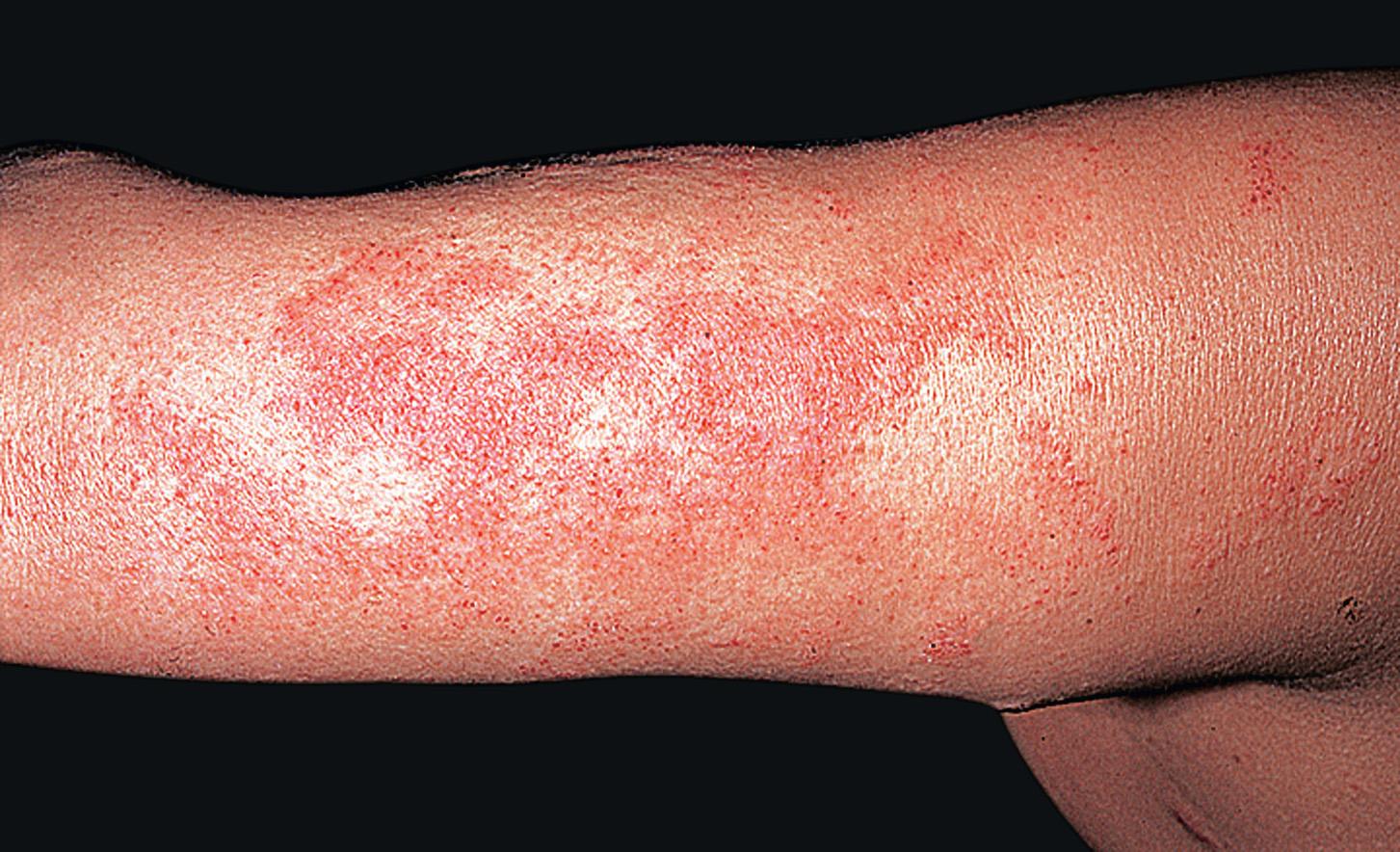 Fig. 2.6, Vesicles are characteristic of the acute phase of eczematous inflammation. Itching is often intense.