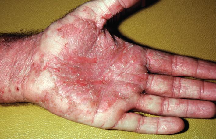 Fig. 2.61, Contact allergy most commonly involves the dorsum of the hands but may involve the palms. Patch testing is essential for refractory or recurrent cases of chronic hand dermatitis. An allergen, after identified, must be avoided for resolution of the rash.
