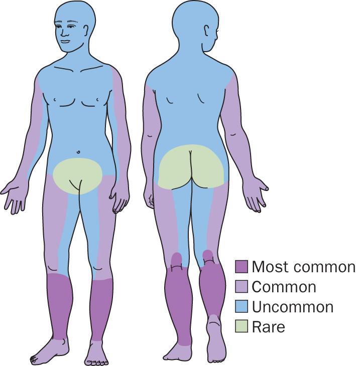 Fig. 2.62, Asteatotic eczema distribution diagram.