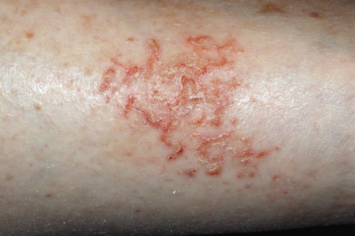 Fig. 2.63, Eczema craquelé is a form of eczema that occurs most typically in the winter when humidity is low. Elderly people are most prone. The skin appears cracked and inflamed.
