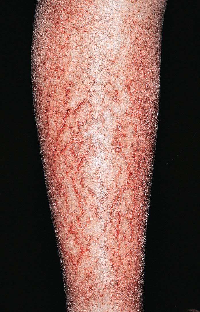 Fig. 2.64, Asteatotic eczema. The skin is very dry, cracked, and fissured. This pattern evolved in an atopic patient who continued to wash excessively dry skin. The skin may be painful.