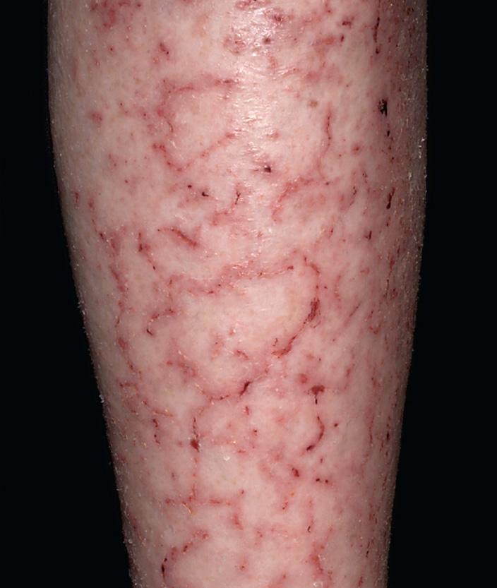 Fig. 2.65, Asteatotic eczema. This may be due to excessive washing of the skin or to winter conditions of cold, low-humidity air. The appearance is of cracking of the skin, superficial fissures, and erythema.