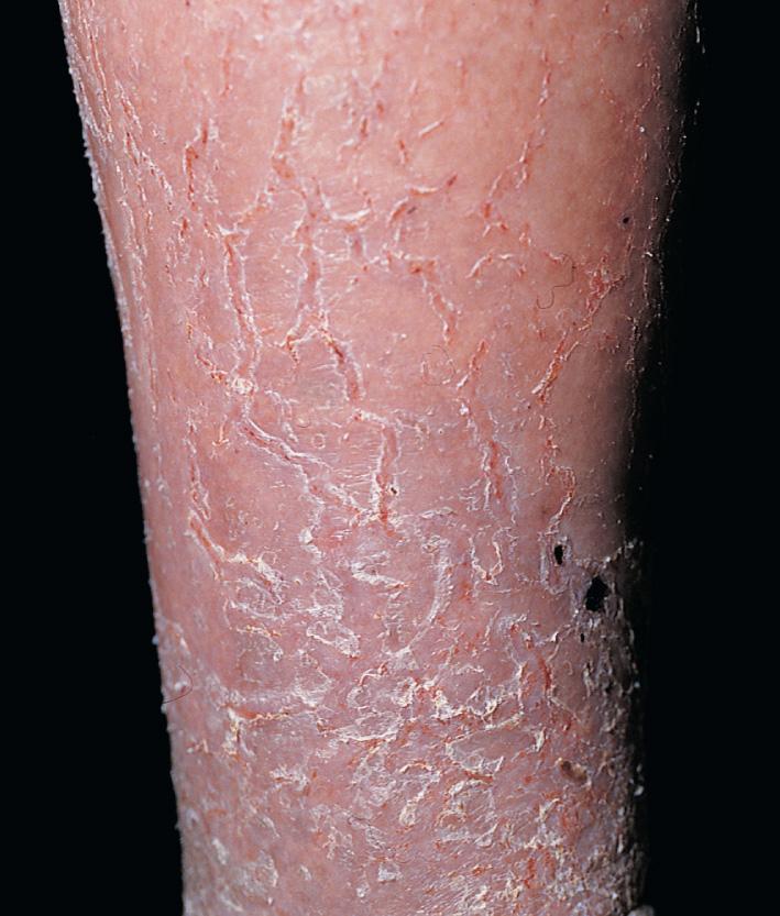 Fig. 2.66, Chronicity of asteatotic eczema leads to increased erythema, scaling, fissuring, and discomfort. Skin is typically pruritic. The fissures appear in a “crazing paving” pattern. Regular use of a bland emollient is extremely helpful in resolving this problem.