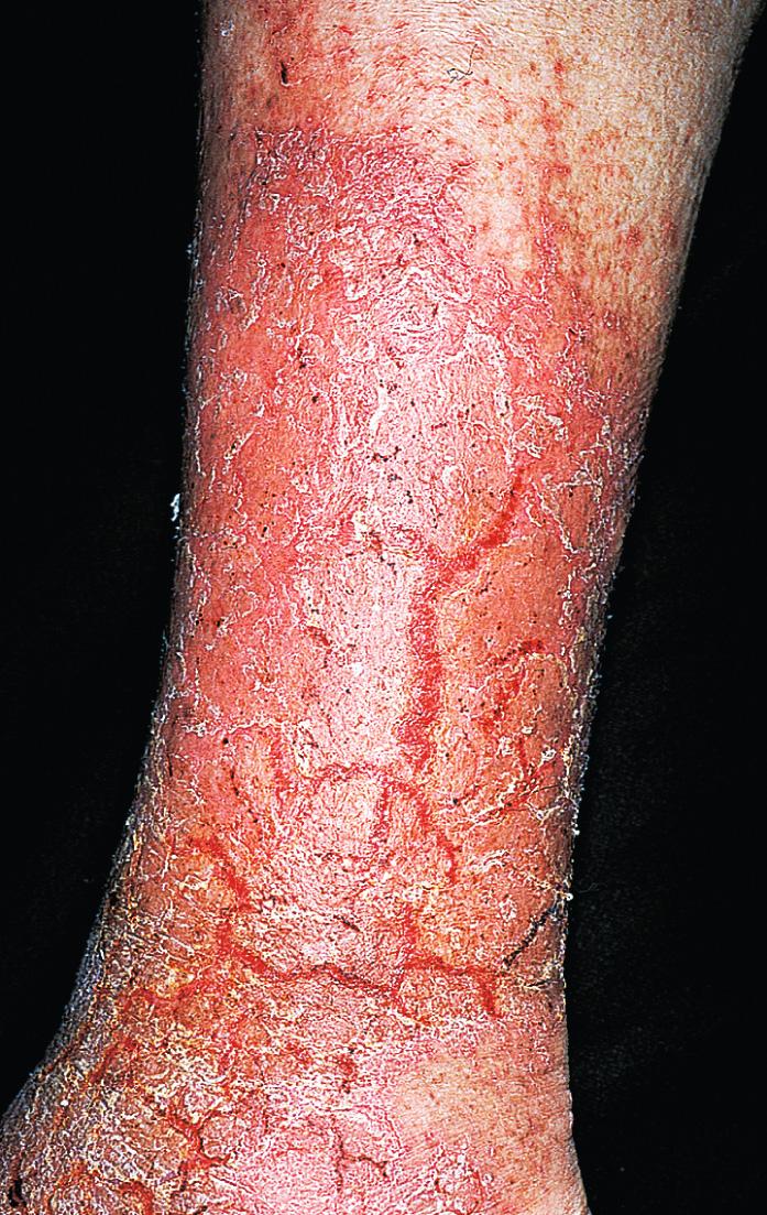 Fig. 2.67, Asteatotic eczema with severe long-standing inflammation. There are large, deep fissures and secondary infection.