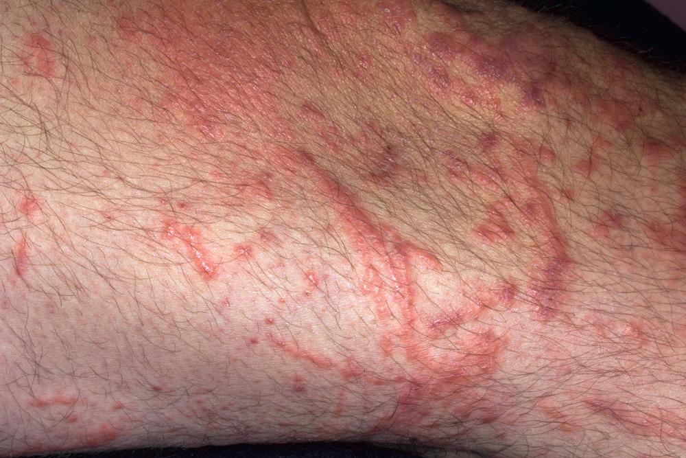 Fig. 2.7, Poison ivy dermatitis. Classic presentation of linear vesicles in streaks suggests plant dermatitis.
