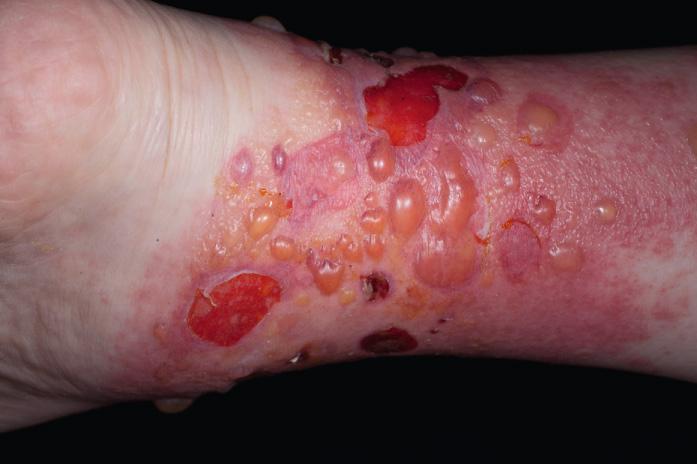 Fig. 2.8, Edema, erosions from large bullae, and vesicles on this limb affected by a severe contact allergy to poison ivy. Itch rather than pain fits with allergy and not infection.