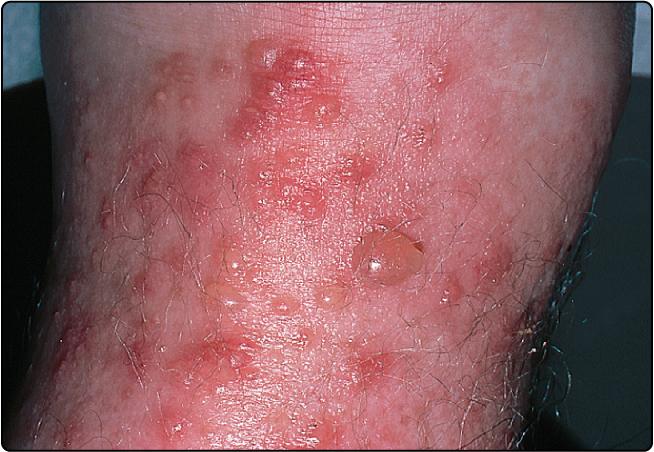 Fig. 19.1, Acute dermatitis (eczema).