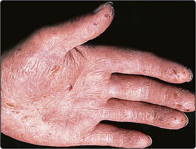 Fig. 19.2, Chronic dermatitis (eczema).