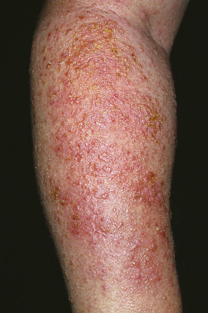 FIG 3.1, Acute eczematous inflammation. Numerous vesicles on an erythematous base. Vesicles may become confluent with time.