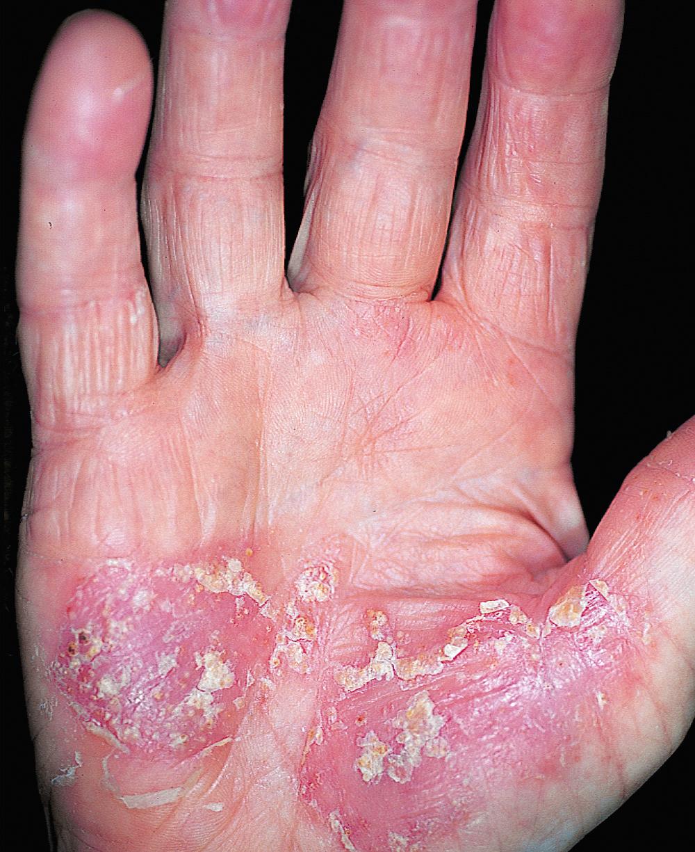 FIG 3.11, Eczema resembling psoriasis. Acute vesicular eczema has evolved into subacute eczema with redness and scaling.