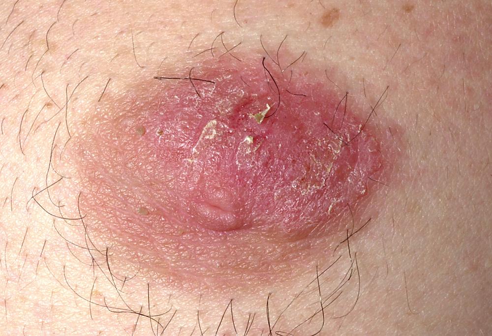 FIG 3.12, Eczema resembling psoriasis. Subacute eczematous inflammation.