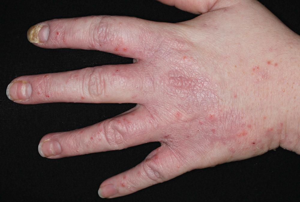 FIG 3.13, Chronic hand dermatitis involving the cuticle results in nail dystrophy.