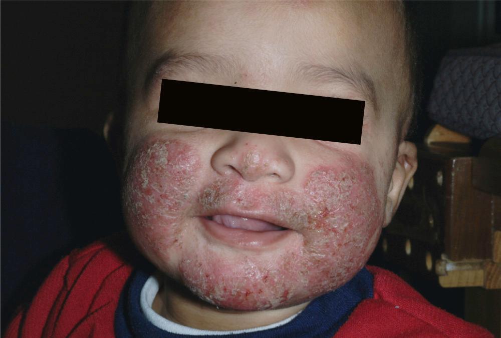 FIG 3.14, Infected eczema. This child has well-demarcated superinfected eroded plaques. This child has impetiginized atopic dermatitis. In children, psoriasis and atopic dermatitis may appear similar.